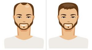 Hair restoration with hair transplants