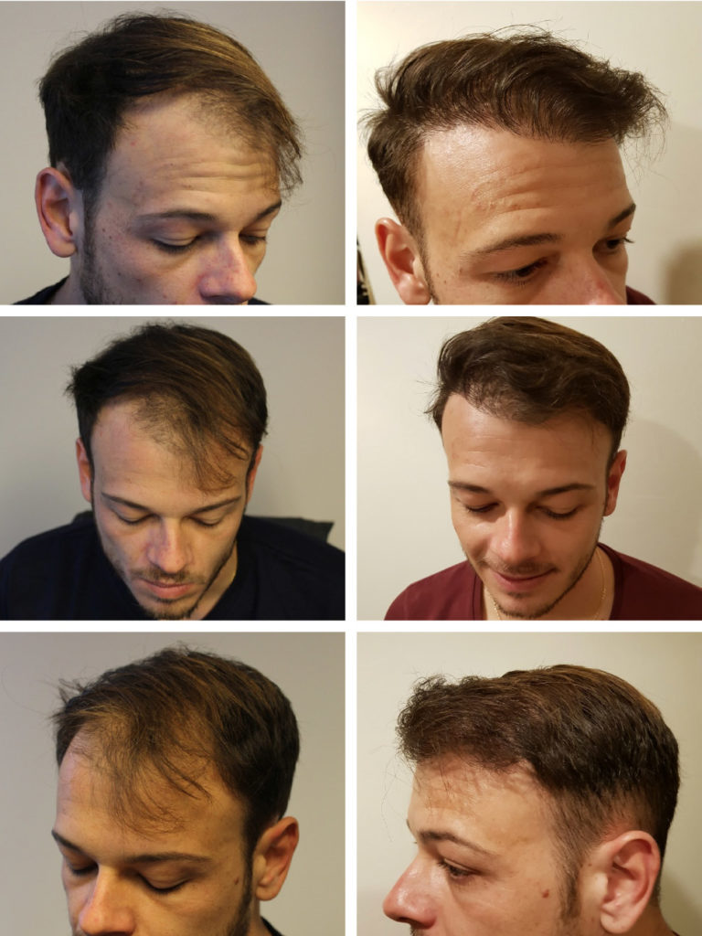 Hair transplants UK - Hungary is a cost-effective alternative