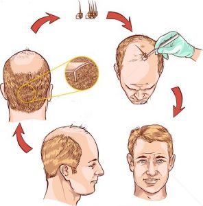 Hair transplant cost London, Exeter, Bristol - UK hair restoration for men