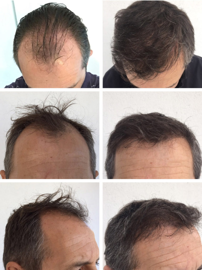 Before and after hair transplant images - High quality scalp rejuvenation  with implants